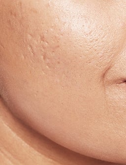 Don’t let acne scarring take hold of your confidence