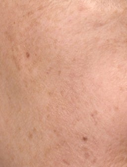 What is skin pigmentation?