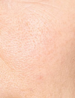 What is skin texture?