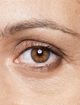 Dark circles: A common concern for many