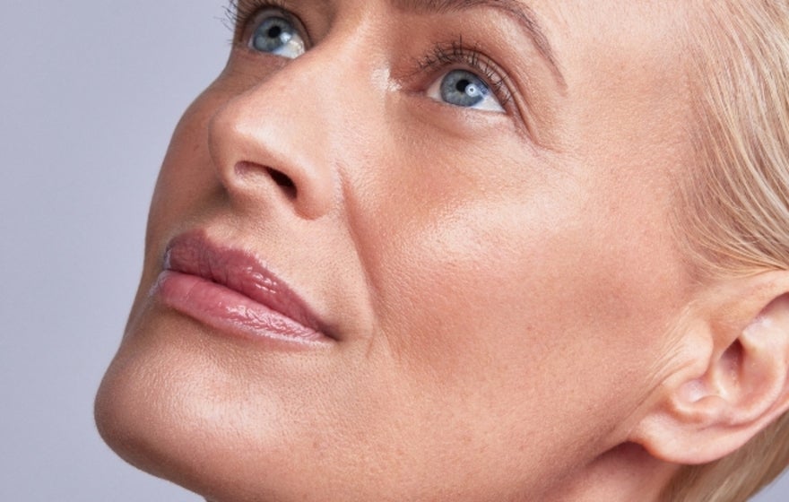 Restylane Cheek filler