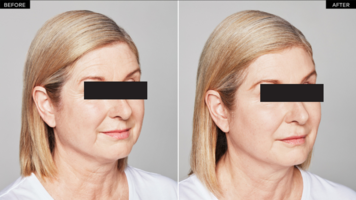 Lyft_before and after
