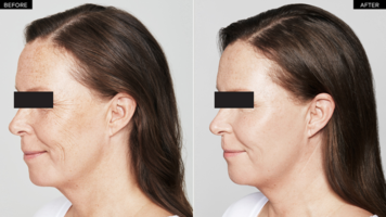 Restylane Skinboosters before after