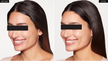 Collagen Stimulator Sculptra