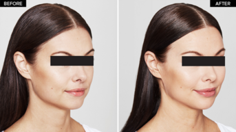 Restylane Kysse Before After