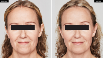 Restylane Volyme Before After