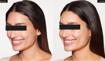 Collagen stimulating treatment