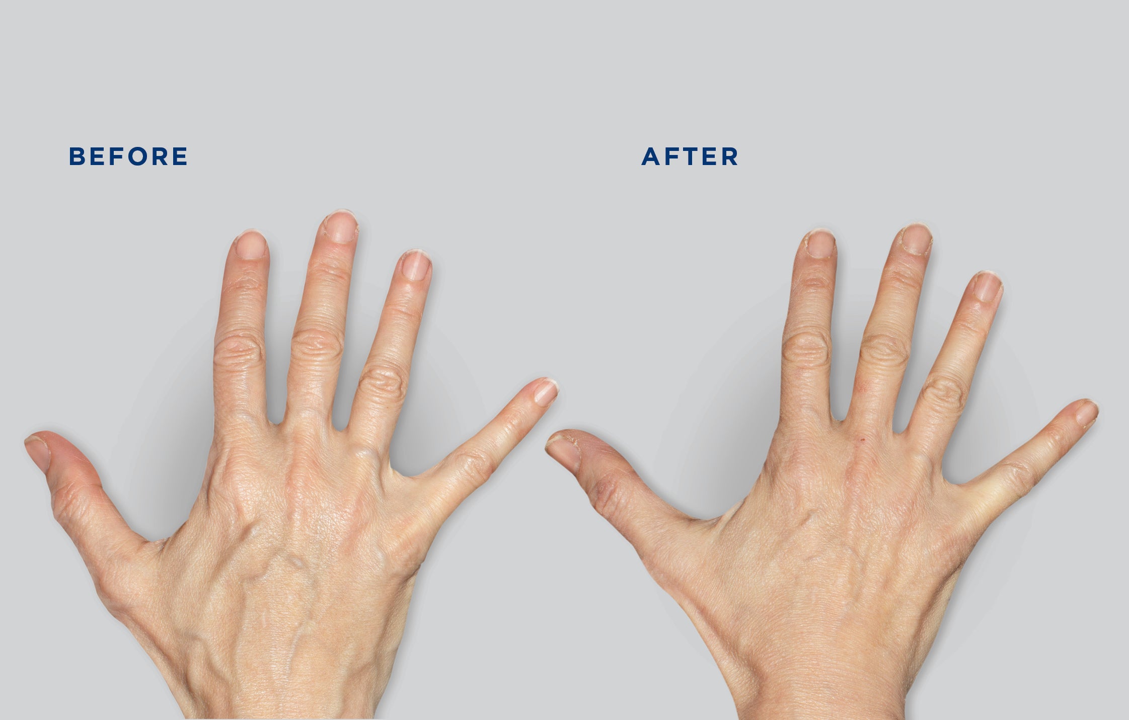 Younger looking hands – a result that lasts