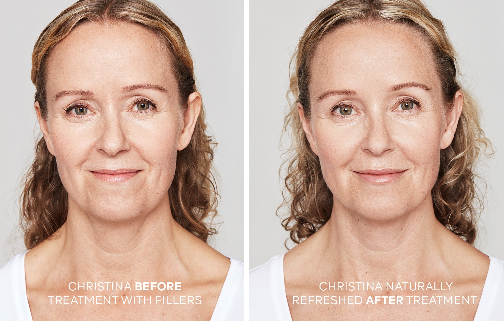 How long do fillers last or are they permanent?