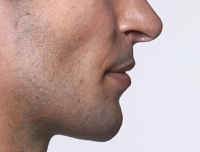 consumer_v3_home_restylane_basmall_lewis_after.jpg
