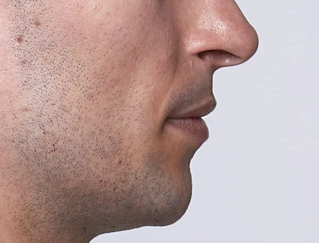 consumer_v3_home_restylane_basmall_lewis_before_0.jpg