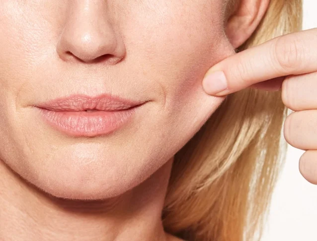 consumer_v3_home_sculptra_basmall_chloe_pinch_after.jpg