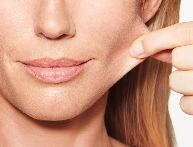 consumer_v3_home_sculptra_basmall_chloe_pinch_before.jpg
