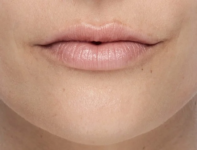 consumer_v3_restylane_lips_basmall_georgia_after.jpg