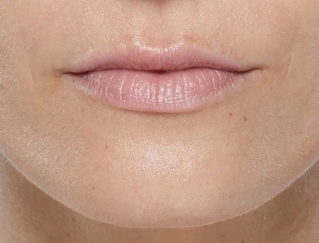 consumer_v3_restylane_lips_basmall_georgia_before.jpg