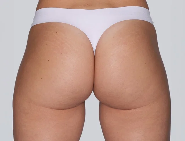 sculptra_body_basmall_aline_after