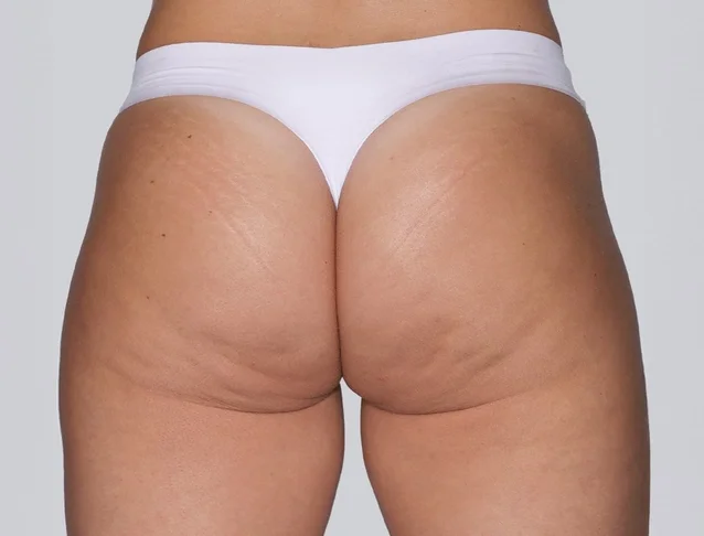 sculptra_body_basmall_aline_before_0