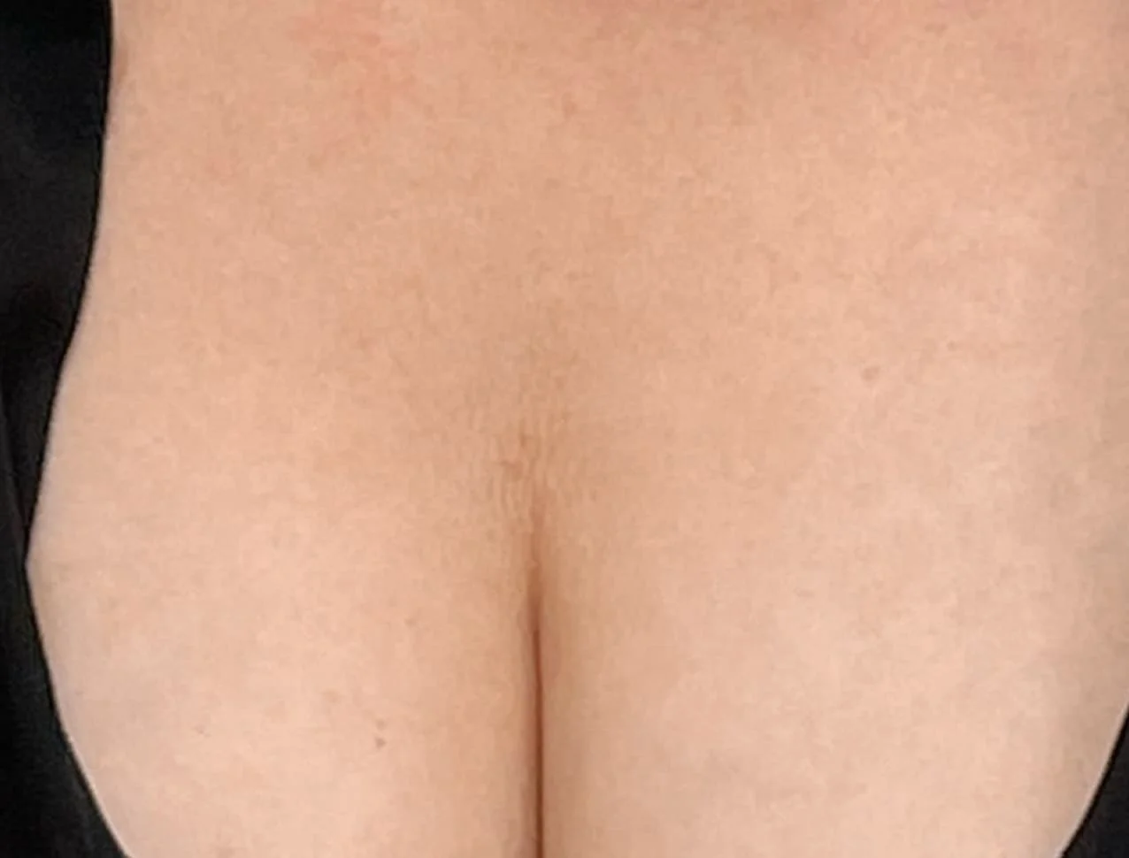 sculptra_body_basmall_maria_after