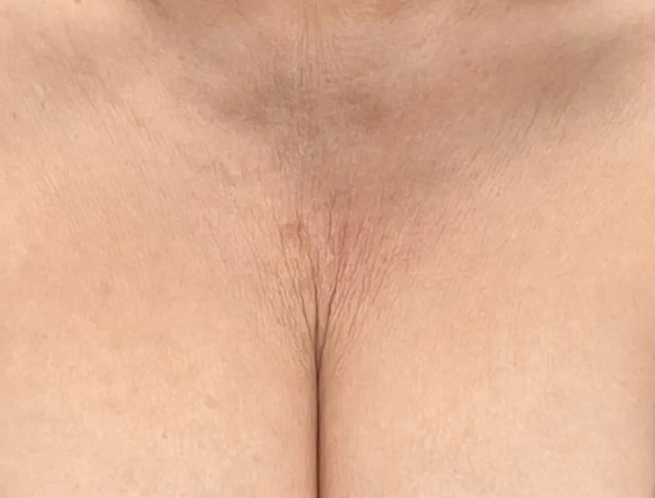 sculptra_body_basmall_maria_before