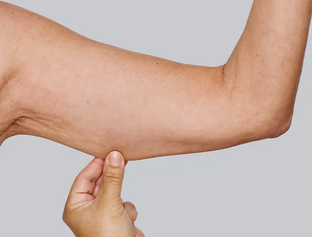 sculptra_body_basmall_suelly_after_0