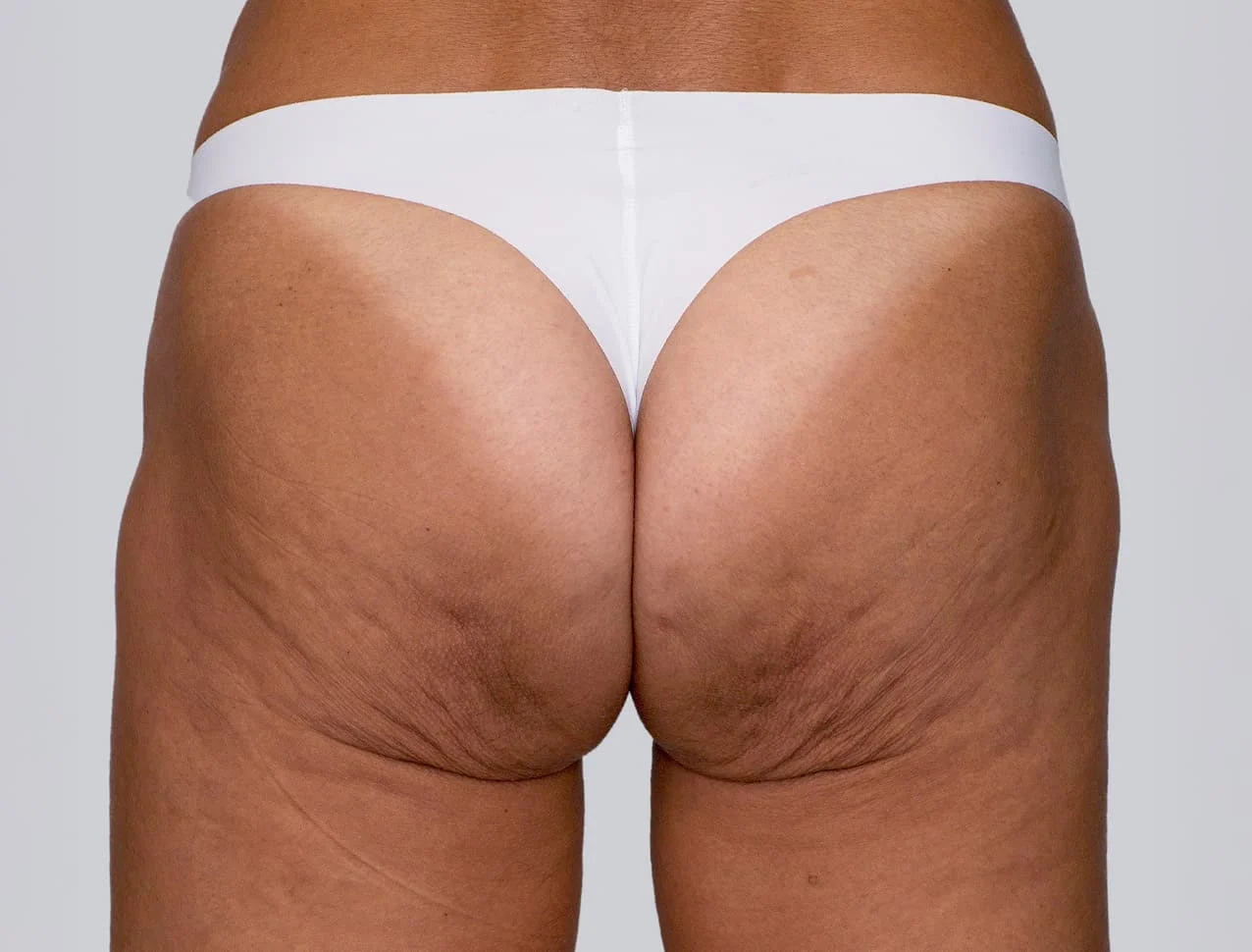 sculptra_body_basmall_valeria_before