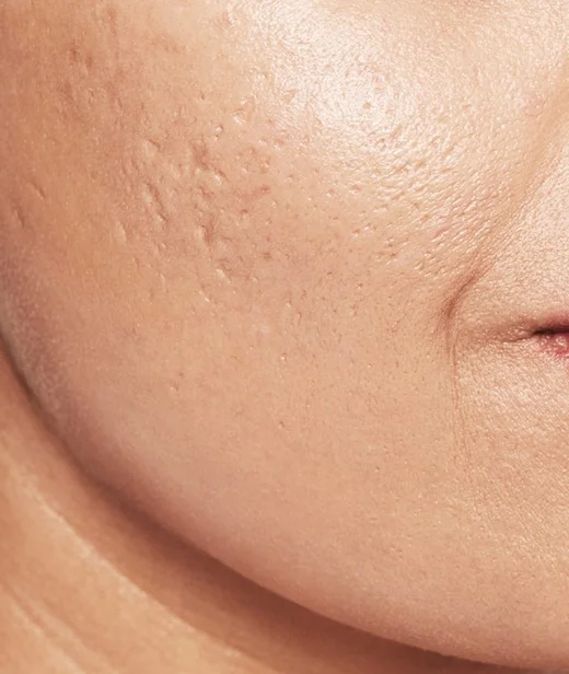 concerns_acnescarremova_dontletacnescarring