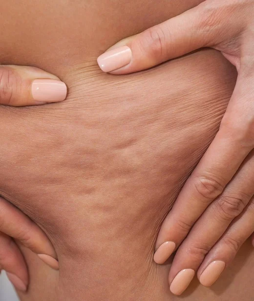 concerns_cellulite_whatiscellulite