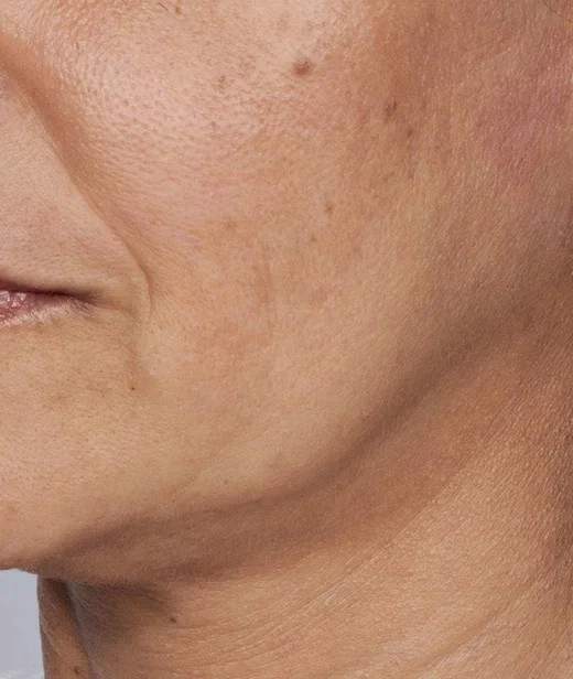 concerns_sagging_skin_whatisskinsagging