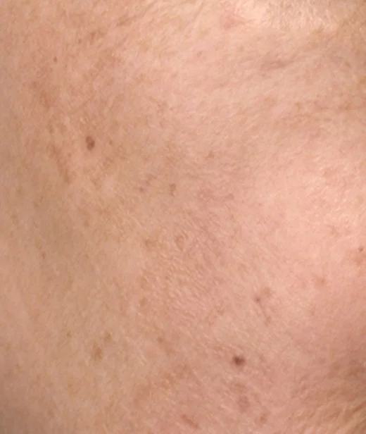 concerns_skinpigmentation_whatisskinpigmentation