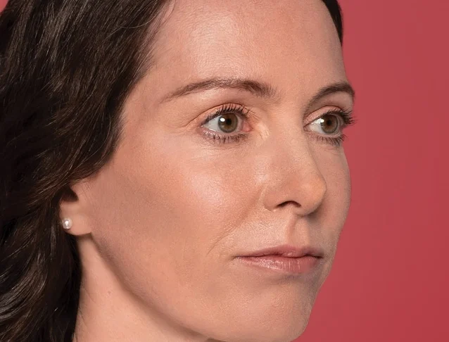 consumer_v3_restylane_cheeks_ba_caterina_after