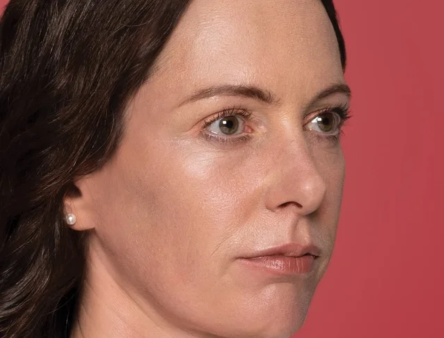 consumer_v3_restylane_cheeks_ba_caterina_before