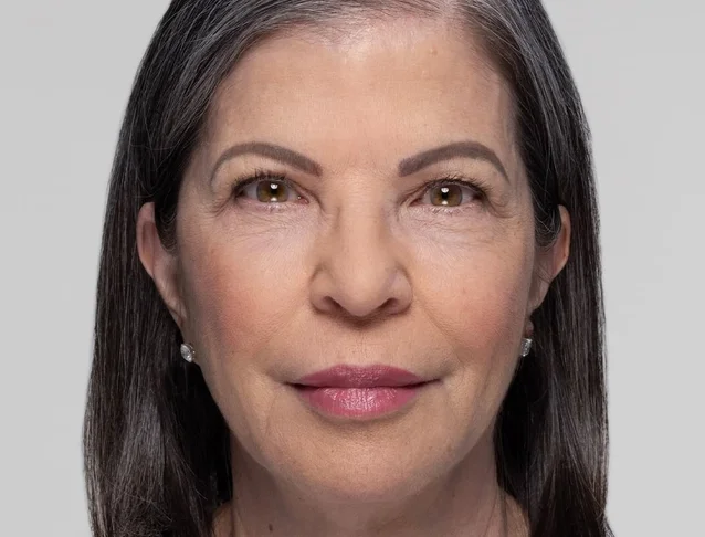 consumer_v3_restylane_cheeks_ba_irene_after