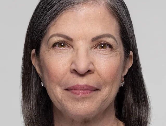 consumer_v3_restylane_cheeks_ba_irene_before