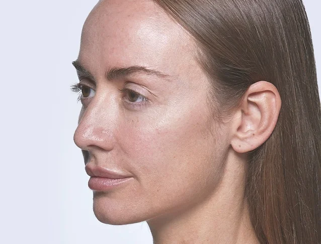 consumer_v3_restylane_cheeks_ba_kerri_after