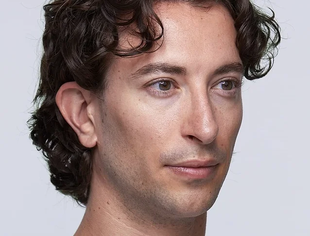 consumer_v3_restylane_cheeks_ba_lewis_before