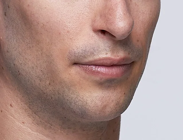 restylane_jawline