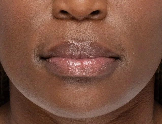 consumer_v3_restylane_lips