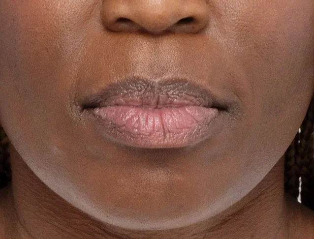 consumer_v3_restylane_lips