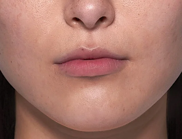 consumer_v3_restylane_lips_basmall_emily_after
