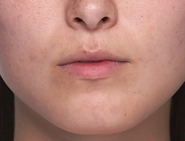 consumer_v3_restylane_lips_basmall_emily_before