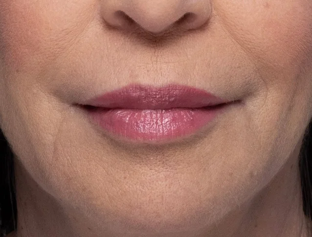 consumer_v3_restylane_lips