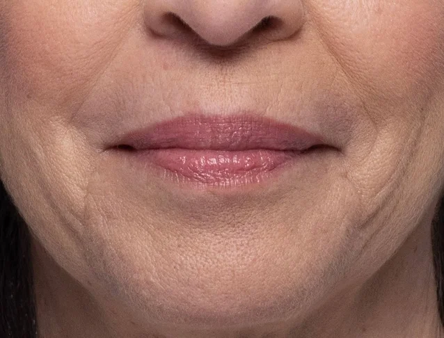 consumer_v3_restylane_lips
