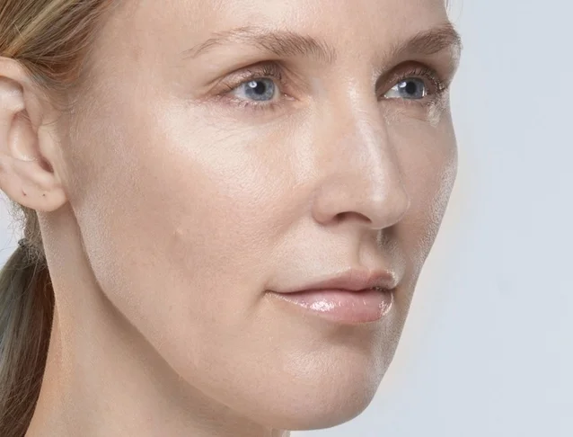 consumer_v3_restylane_lips_basmall_kim_after