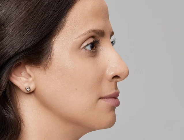 consumer_v3_restylane_nose_basmall_anahita_after