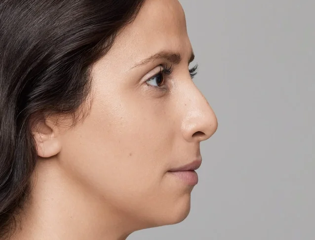 consumer_v3_restylane_nose_basmall_anahita_before