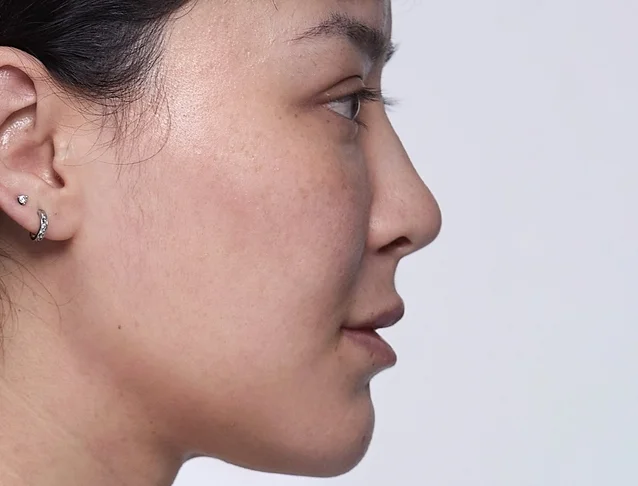 consumer_v3_restylane_nose_basmall_kaytian_after