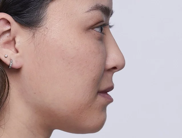 consumer_v3_restylane_nose_basmall_kaytian_before