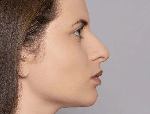 consumer_v3_restylane_nose_basmall_rayssa_after