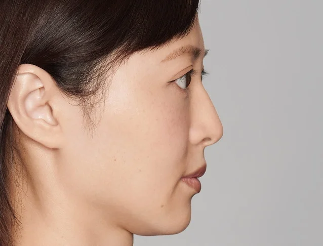 consumer_v3_restylane_nose_basmall_yu_after