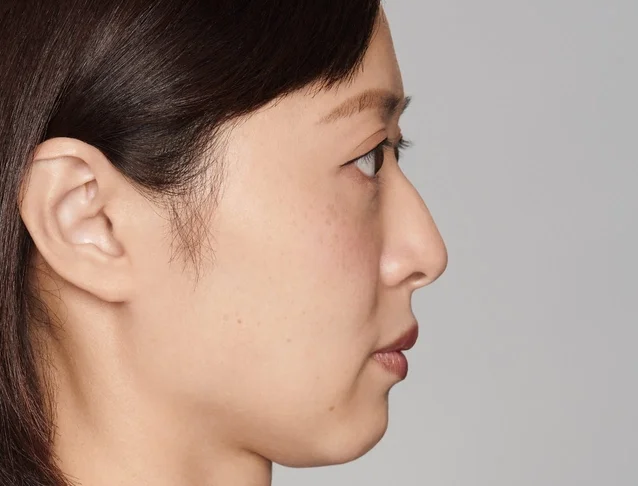 consumer_v3_restylane_nose_basmall_yu_before